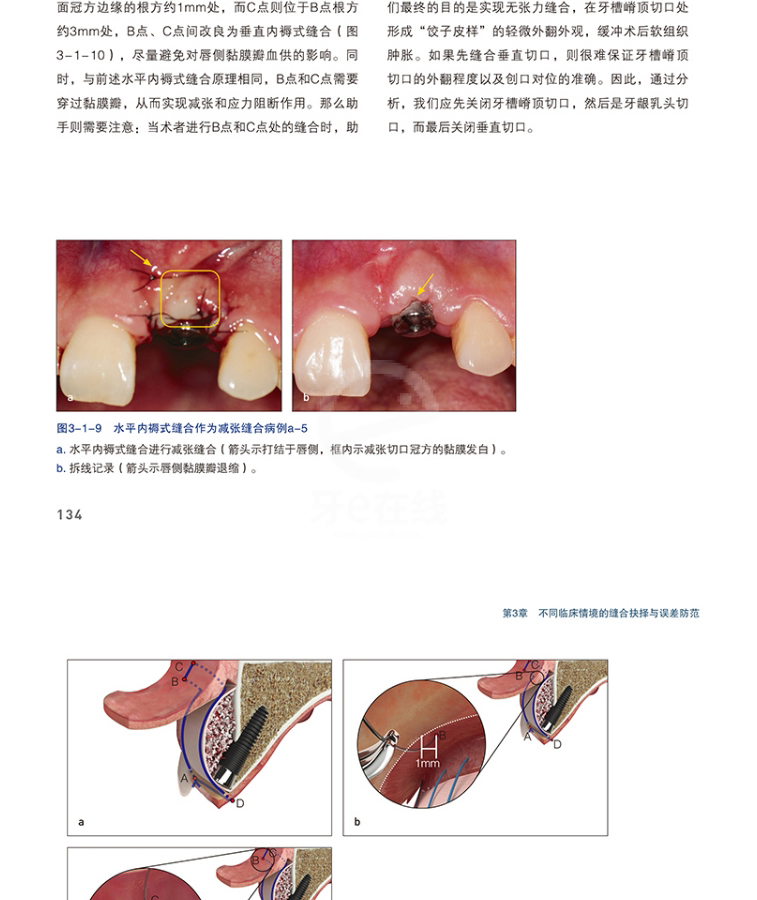 精准缝合-种植及相关术式中的应用、牙e书城、本,3750357001-牙e在线 牙科综合性服务型电商平台